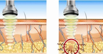 Ultrasonic Fat Cavitation